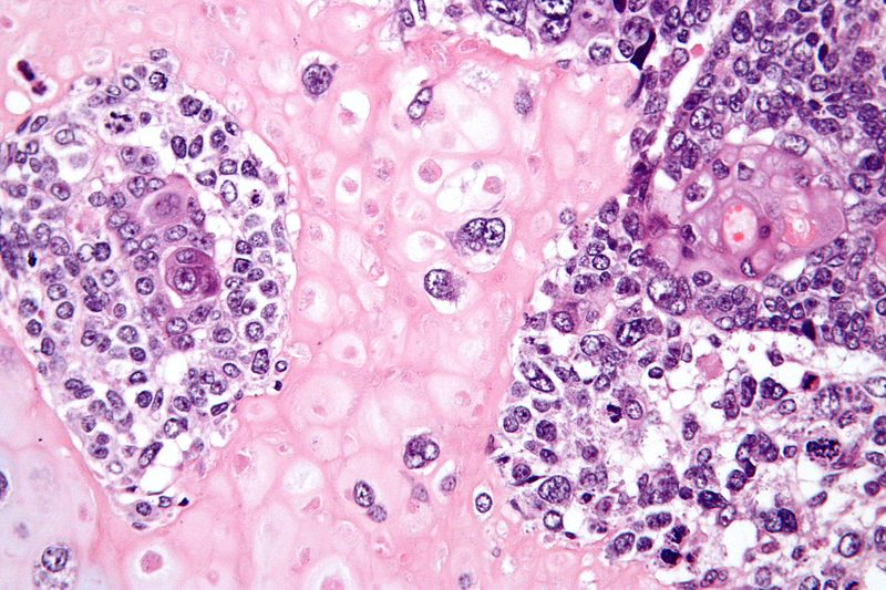 Illustration for article titled Cancer is just as deadly as it was 50 years ago. Here's why that's about to change.